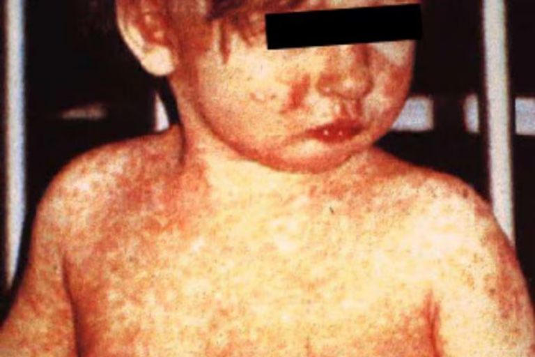 A Deadly Measles Outbreak Is Spreading How Safe Is Lorain?