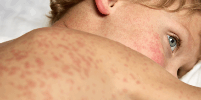 Are You Really Protected? The Truth About Measles Risk in Lorain County